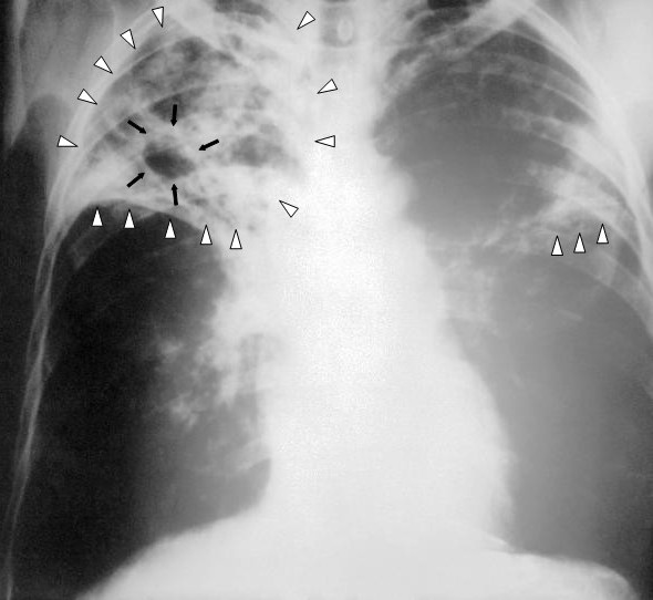 Brasil avança em parceria para novas vacinas contra tuberculose.